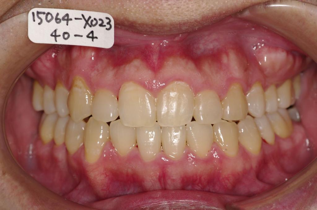 歯並び・咬み合わせ・八重歯・乱杭歯の矯正治療後口内写真NO.1131