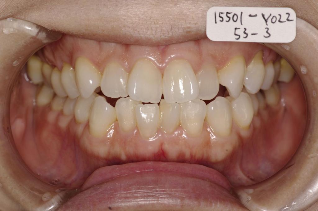 歯並び・咬み合わせ・八重歯・乱杭歯の矯正治療前口内写真NO.1132