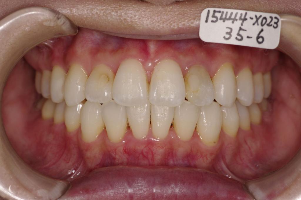 歯並び・咬み合わせ・八重歯・乱杭歯の矯正治療後口内写真NO.1133