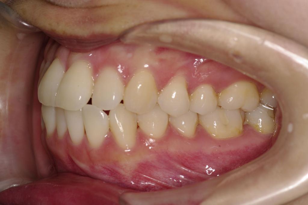 歯並び・咬み合わせ・八重歯・乱杭歯の矯正治療前口内写真NO.1134