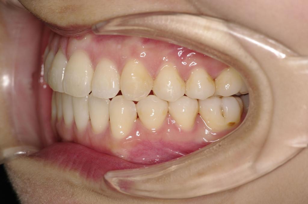 歯並び・咬み合わせ・八重歯・乱杭歯の矯正治療後口内写真NO.1134