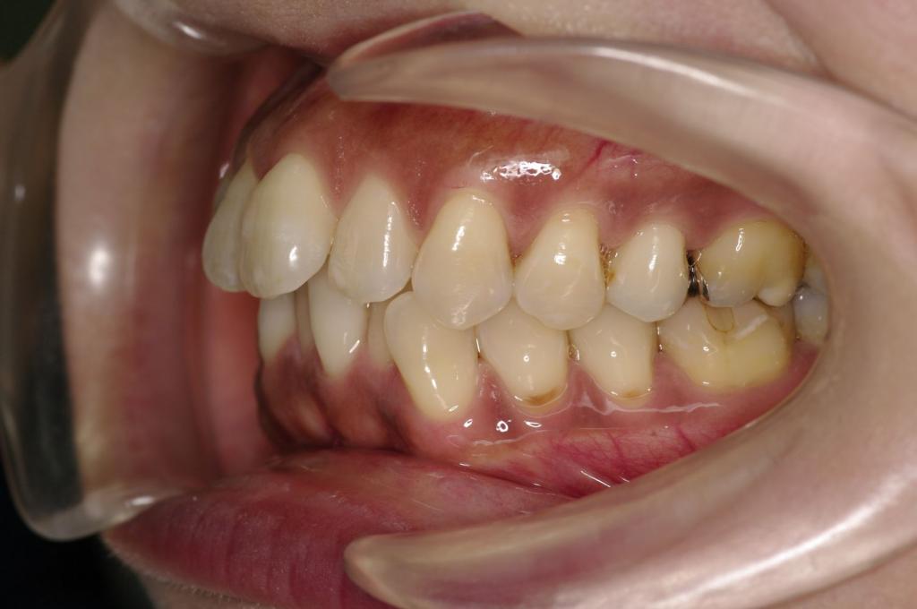 歯並び・咬み合わせ・八重歯・乱杭歯の矯正治療前口内写真NO.1136