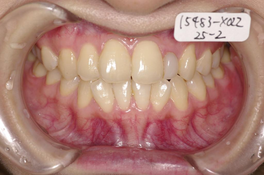 歯並び・咬み合わせ・八重歯・乱杭歯の矯正治療前口内写真NO.1137