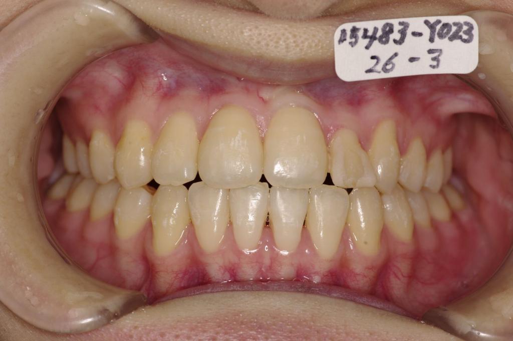 歯並び・咬み合わせ・八重歯・乱杭歯の矯正治療後口内写真NO.1137