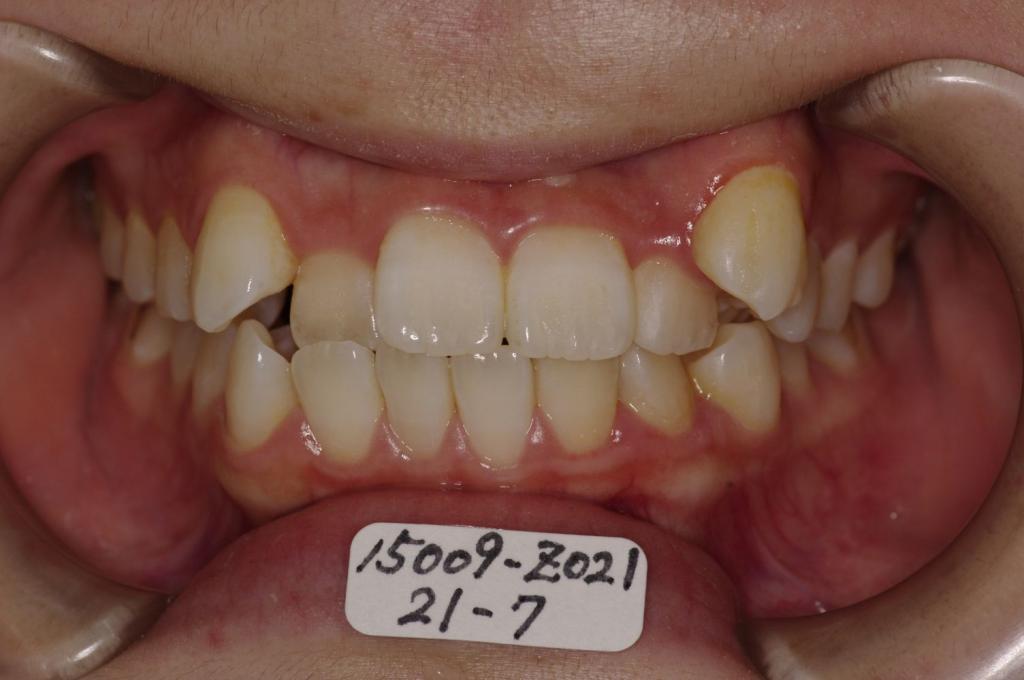 歯並び・咬み合わせ・八重歯・乱杭歯の矯正治療前口内写真NO.1138