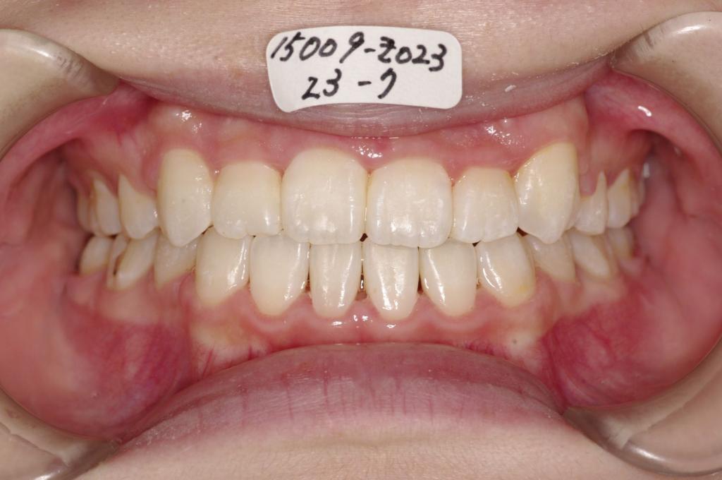 歯並び・咬み合わせ・八重歯・乱杭歯の矯正治療後口内写真NO.1138