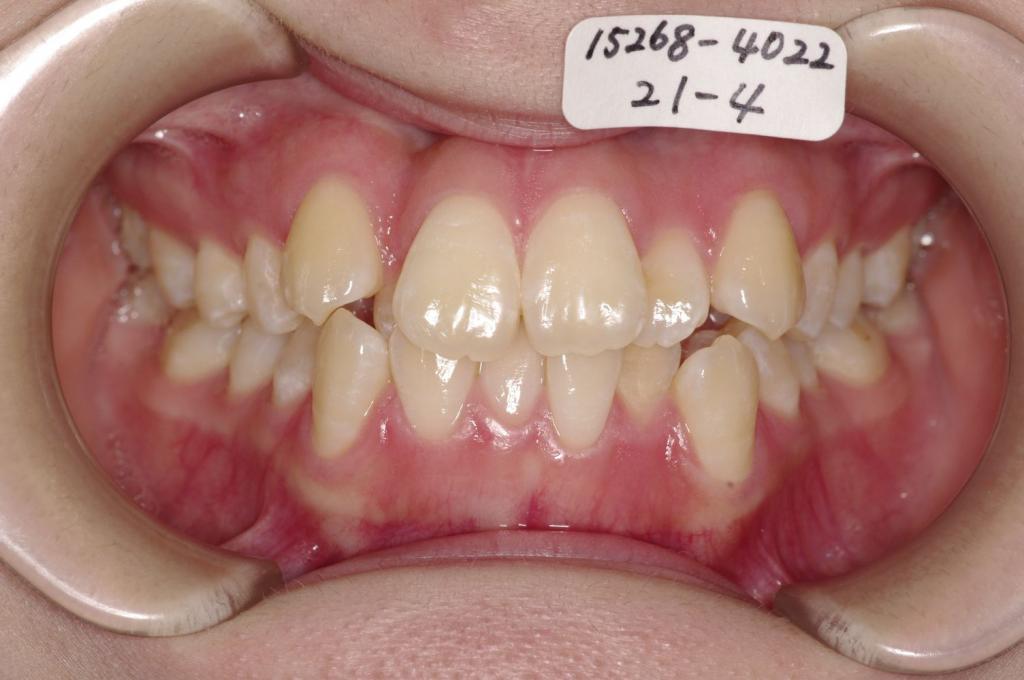 歯並び・咬み合わせ・八重歯・乱杭歯の矯正治療前口内写真NO.1147