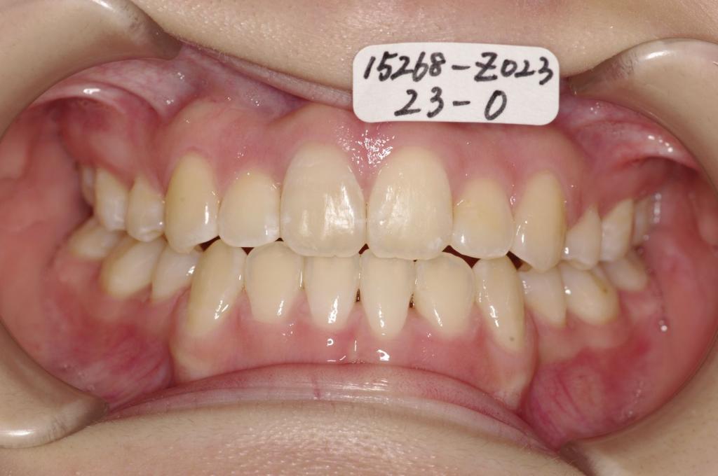 歯並び・咬み合わせ・八重歯・乱杭歯の矯正治療後口内写真NO.1147
