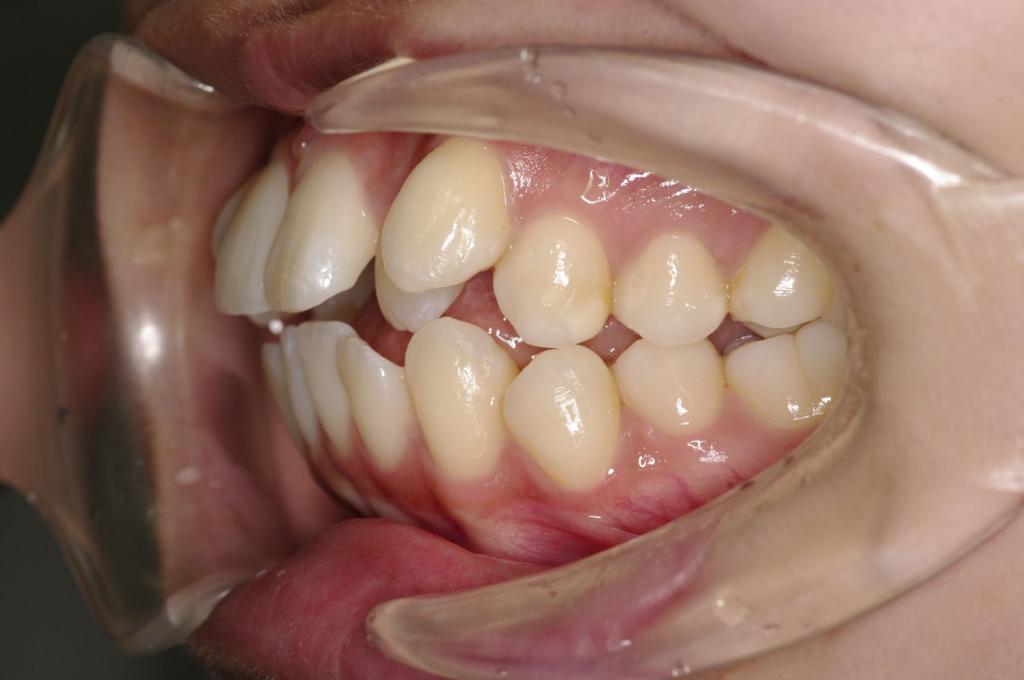 歯並び・咬み合わせ・八重歯・乱杭歯の矯正治療前口内写真NO.1148
