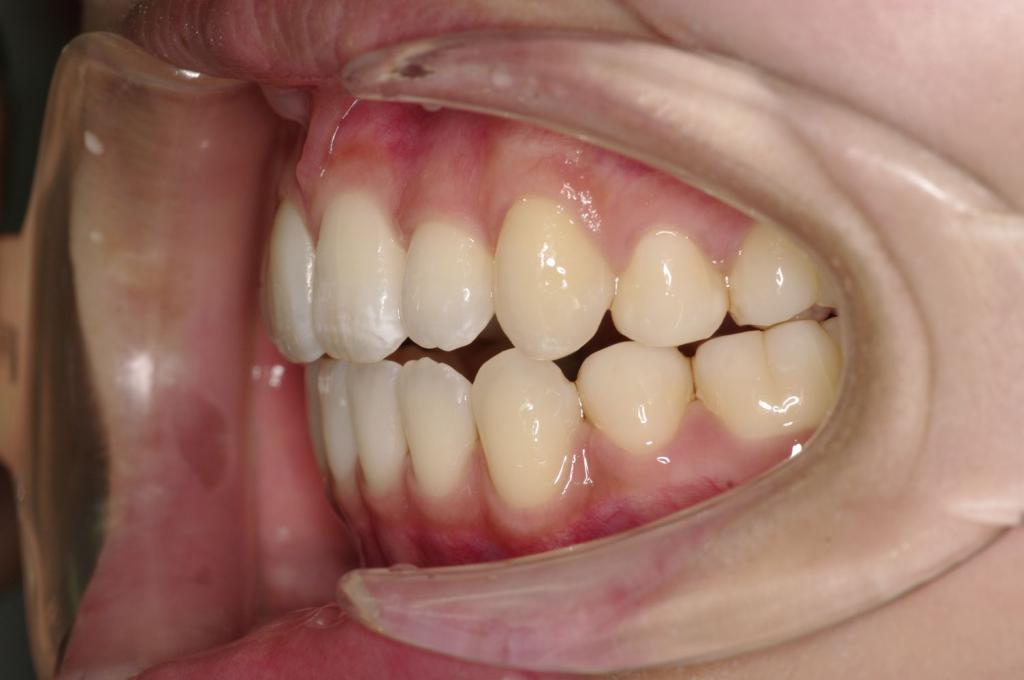 歯並び・咬み合わせ・八重歯・乱杭歯の矯正治療後口内写真NO.1148