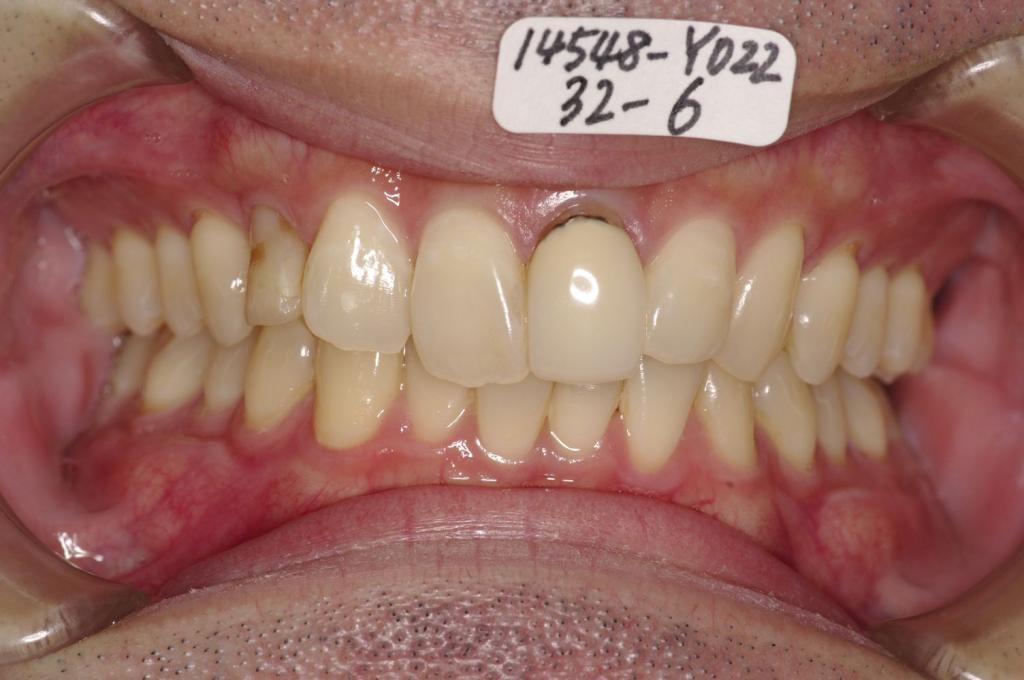 歯並び・咬み合わせ・八重歯・乱杭歯の矯正治療前口内写真NO.1167