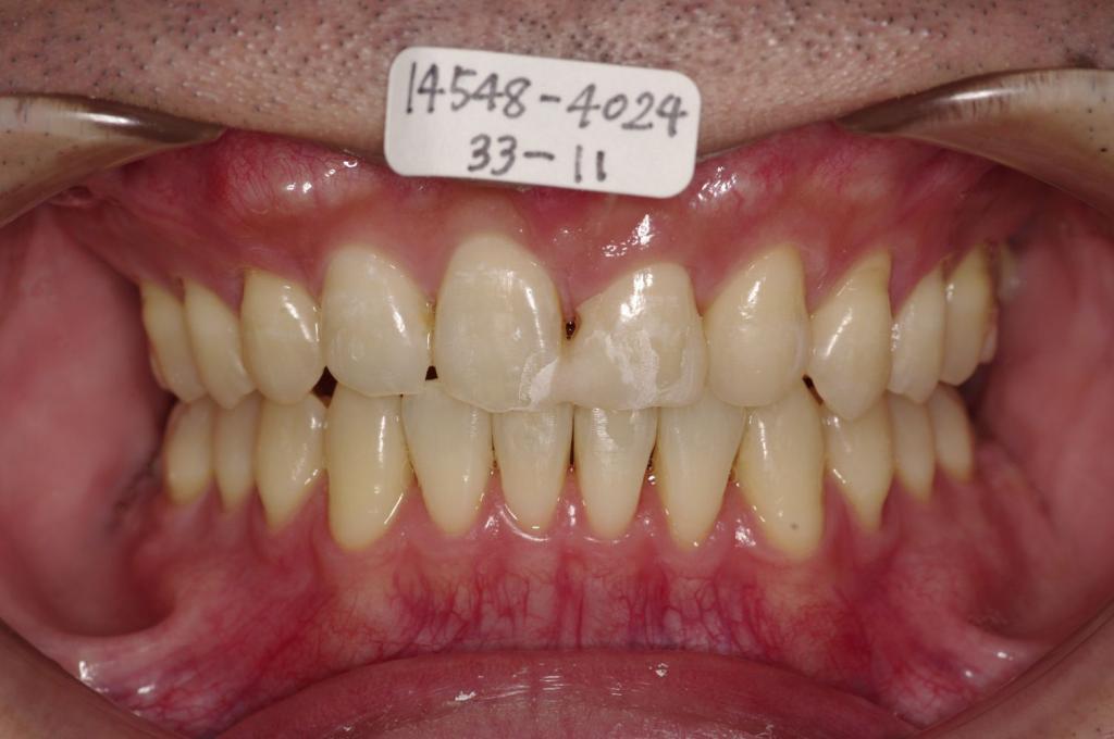 歯並び・咬み合わせ・八重歯・乱杭歯の矯正治療後口内写真NO.1167