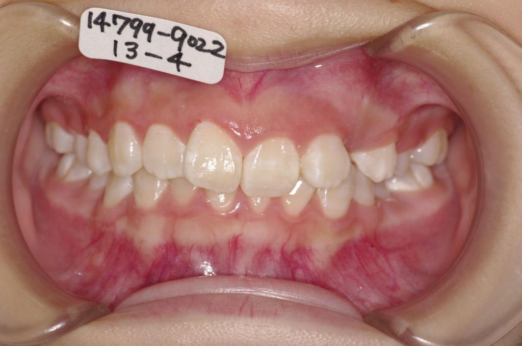 歯並び・咬み合わせ・八重歯・乱杭歯の矯正治療前口内写真NO.1168