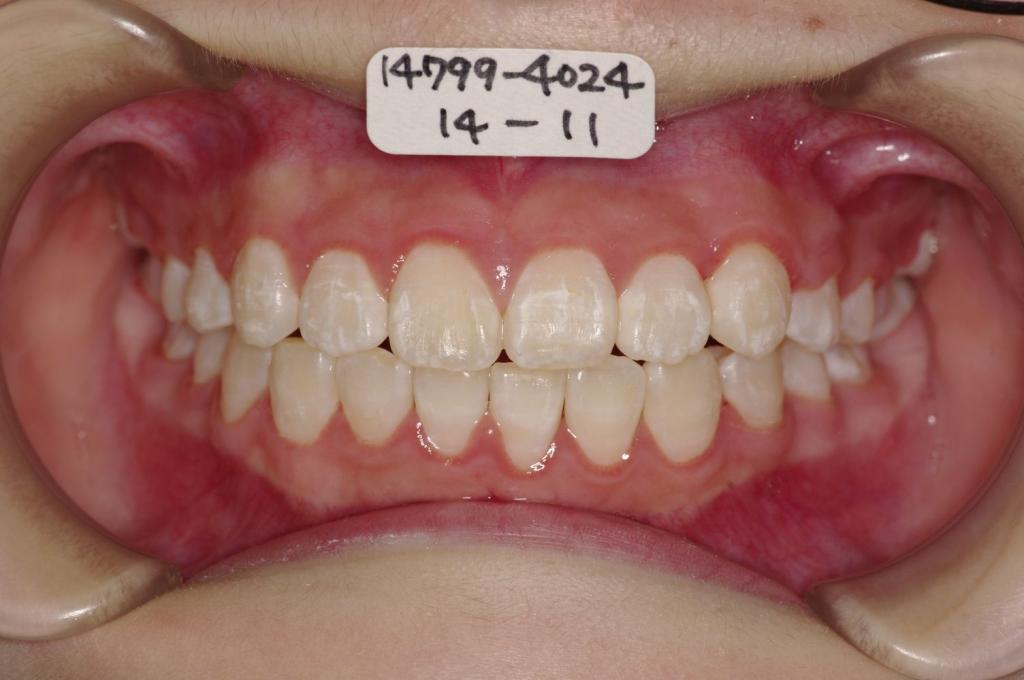 歯並び・咬み合わせ・八重歯・乱杭歯の矯正治療後口内写真NO.1168