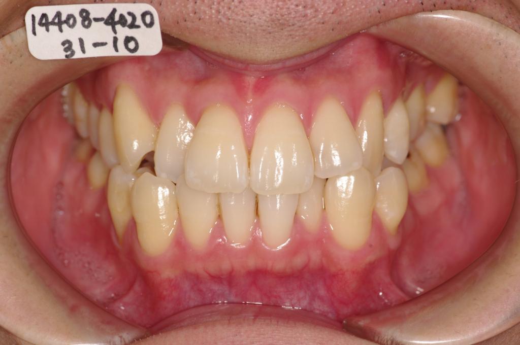 歯並び・咬み合わせ・八重歯・乱杭歯の矯正治療前口内写真NO.1169