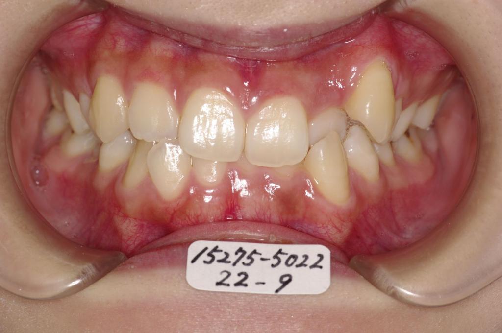 歯並び・咬み合わせ・八重歯・乱杭歯の矯正治療前口内写真NO.1170