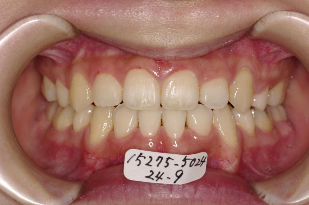 歯並び・咬み合わせ・八重歯・乱杭歯の矯正治療後口内写真NO.1170