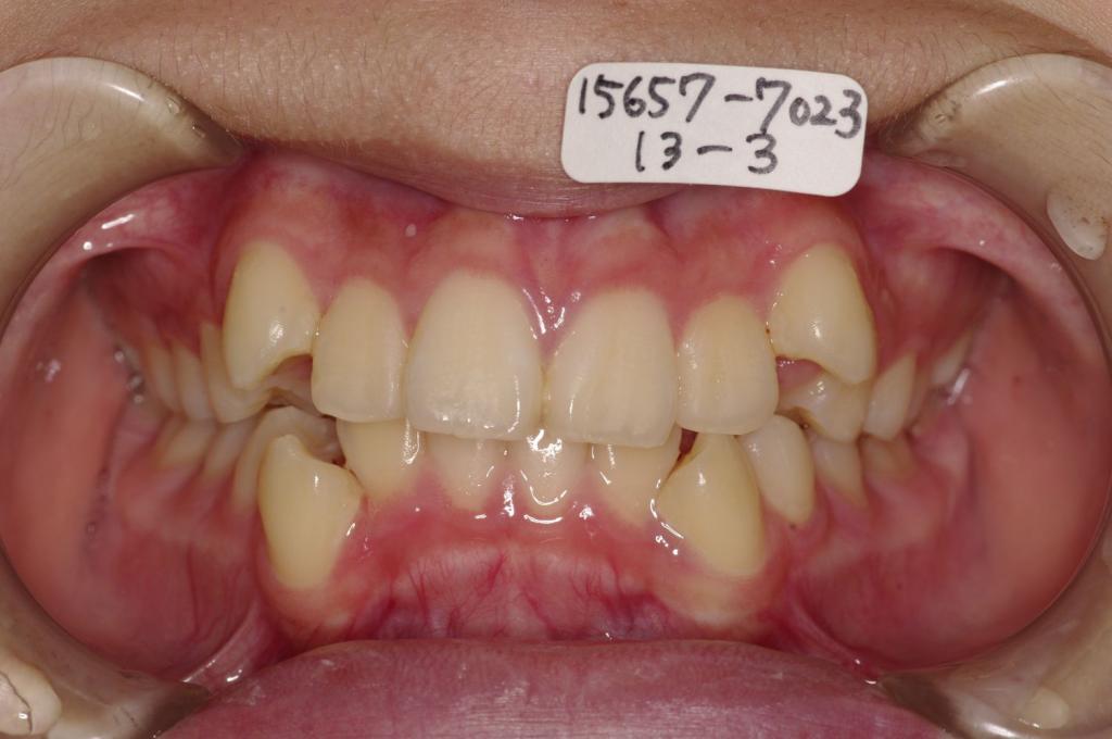 歯並び・咬み合わせ・八重歯・乱杭歯の矯正治療前口内写真NO.1171