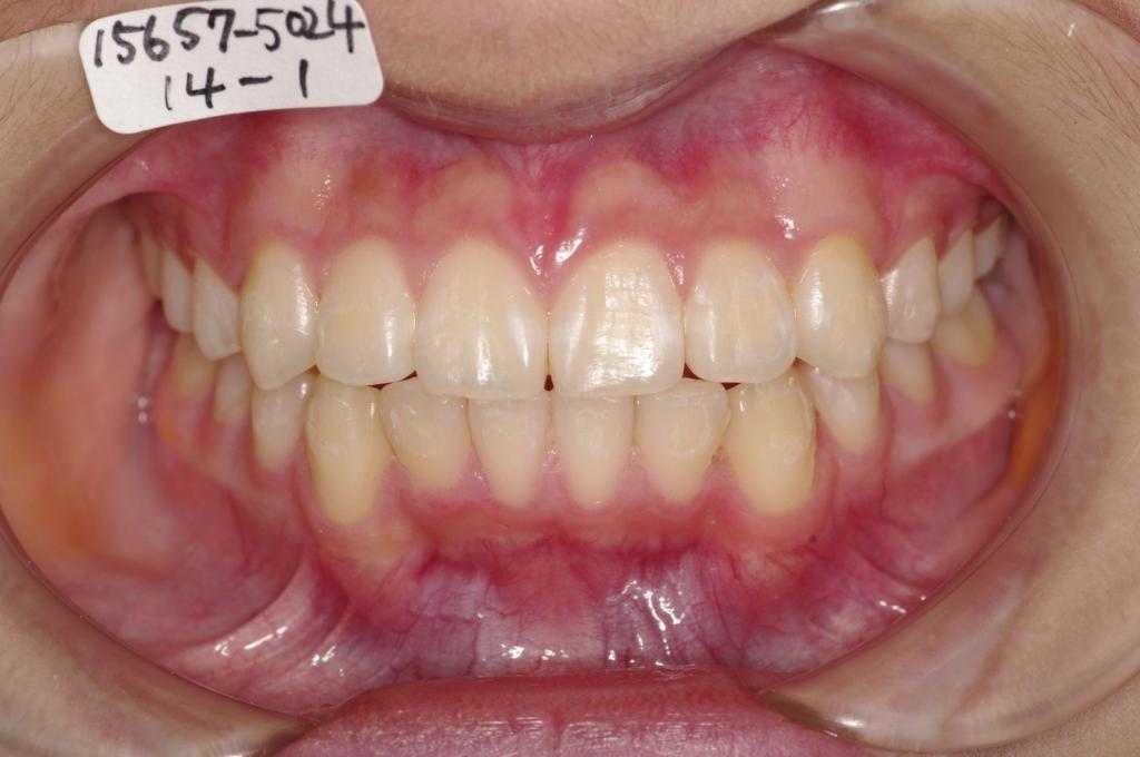 歯並び・咬み合わせ・八重歯・乱杭歯の矯正治療後口内写真NO.1171