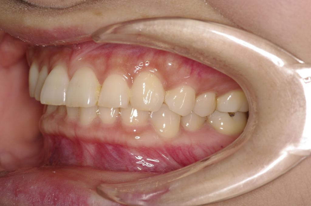 歯並び・咬み合わせ・八重歯・乱杭歯の矯正治療前口内写真NO.1172