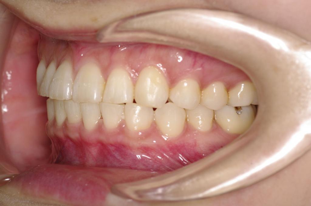 歯並び・咬み合わせ・八重歯・乱杭歯の矯正治療後口内写真NO.1172