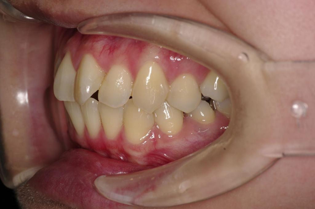 歯並び・咬み合わせ・八重歯・乱杭歯の矯正治療前口内写真NO.1173