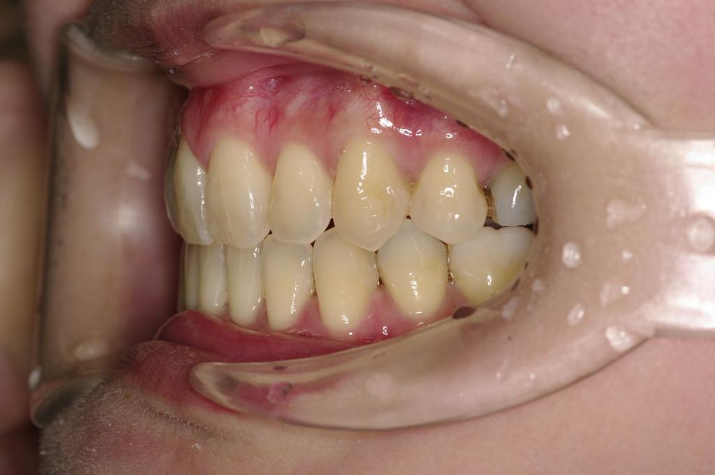 歯並び・咬み合わせ・八重歯・乱杭歯の矯正治療後口内写真NO.1173