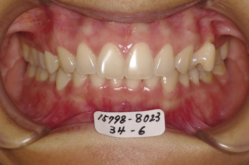 歯並び・咬み合わせ・八重歯・乱杭歯の矯正治療前口内写真NO.1174