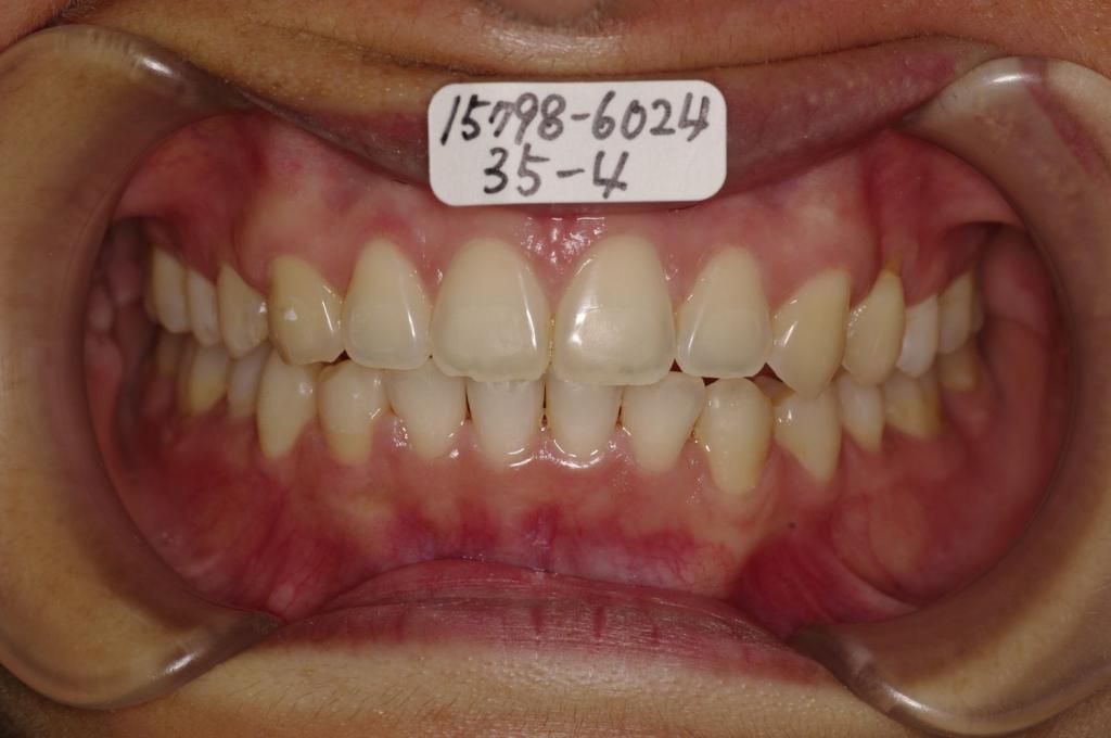 歯並び・咬み合わせ・八重歯・乱杭歯の矯正治療後口内写真NO.1174