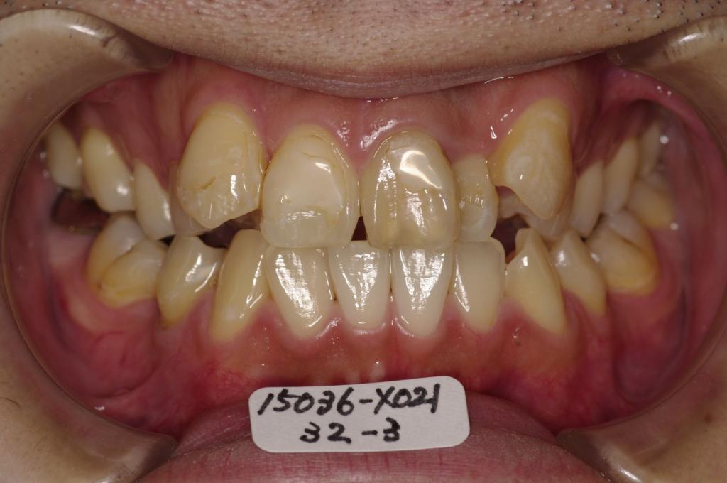 歯並び・咬み合わせ・八重歯・乱杭歯の矯正治療前口内写真NO.1175