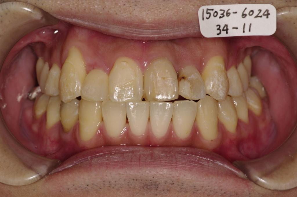 歯並び・咬み合わせ・八重歯・乱杭歯の矯正治療後口内写真NO.1175