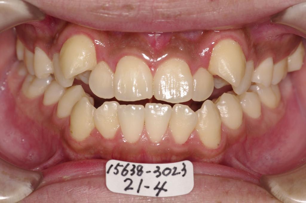 歯並び・咬み合わせ・八重歯・乱杭歯の矯正治療前口内写真NO.1176