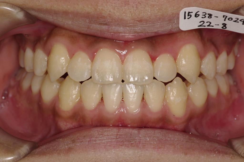 歯並び・咬み合わせ・八重歯・乱杭歯の矯正治療後口内写真NO.1176