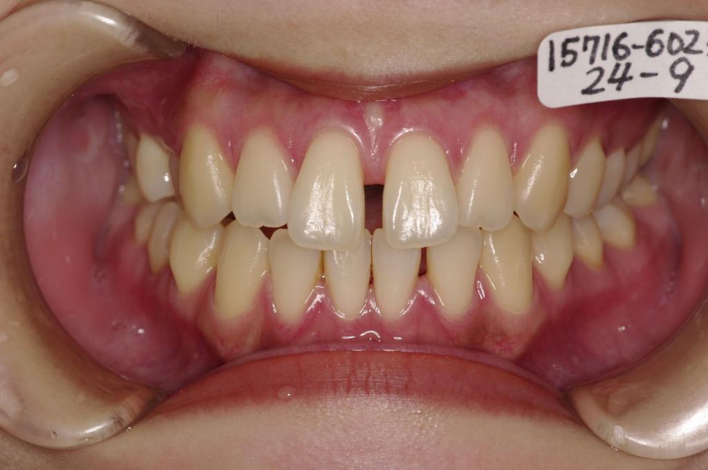 歯並び・咬み合わせ・八重歯・乱杭歯の矯正治療前口内写真NO.1177