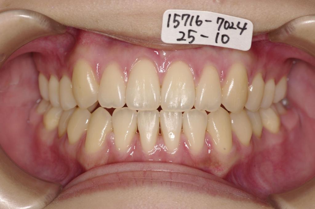 歯並び・咬み合わせ・八重歯・乱杭歯の矯正治療後口内写真NO.1177
