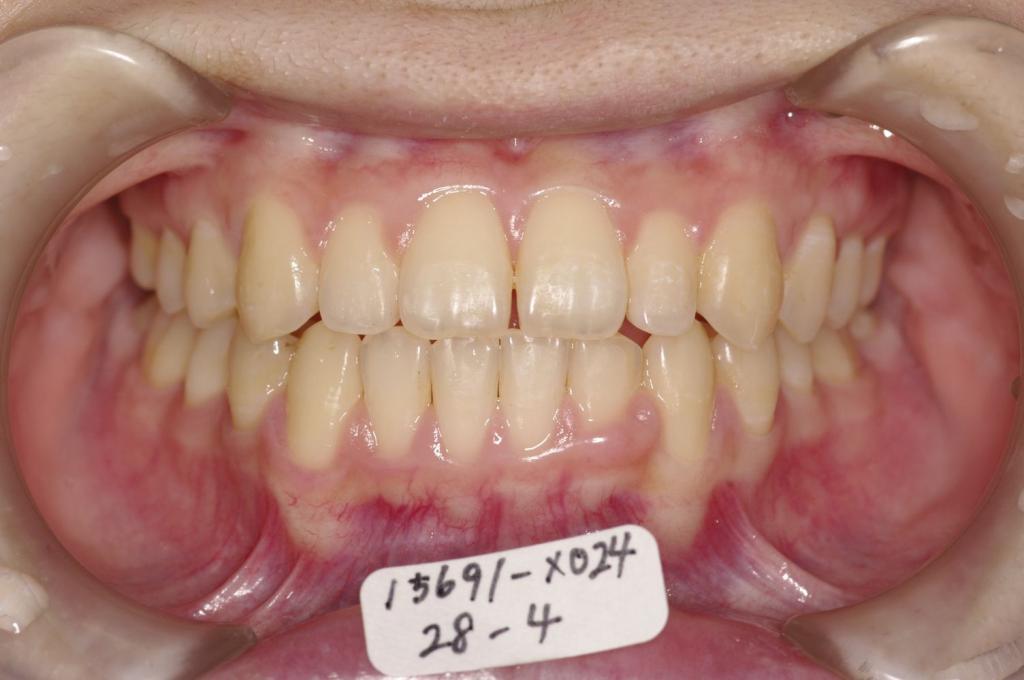 歯並び・咬み合わせ・八重歯・乱杭歯の矯正治療後口内写真NO.1181