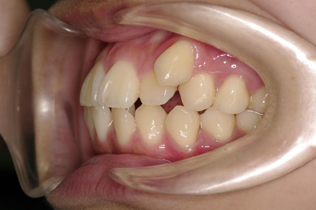 歯並び・咬み合わせ・八重歯・乱杭歯の矯正治療前口内写真NO.1220