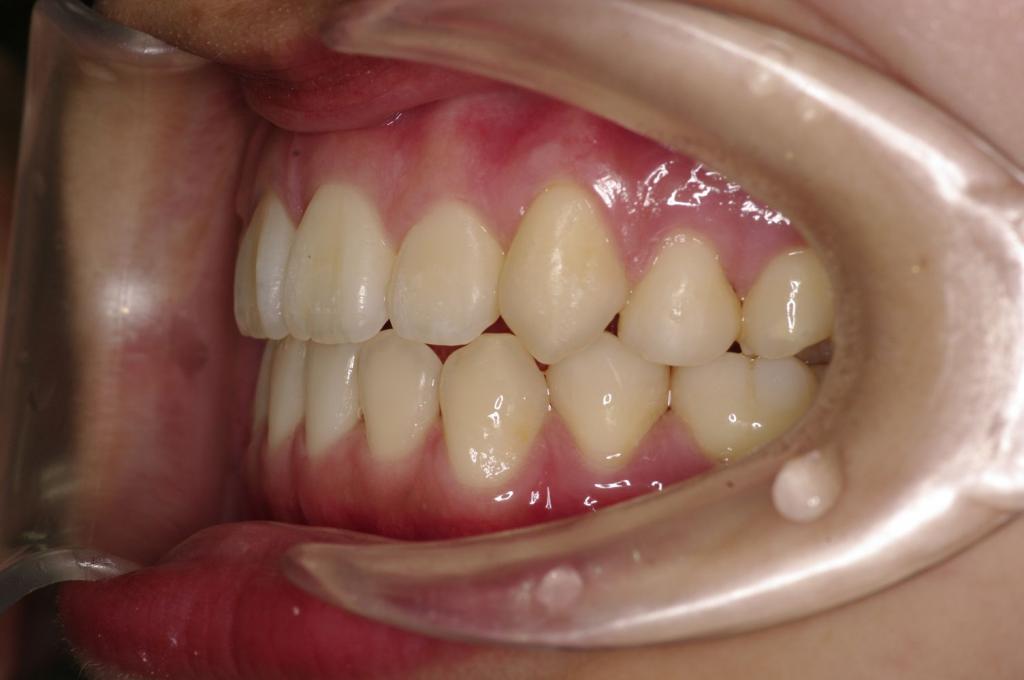 歯並び・咬み合わせ・八重歯・乱杭歯の矯正治療後口内写真NO.1220