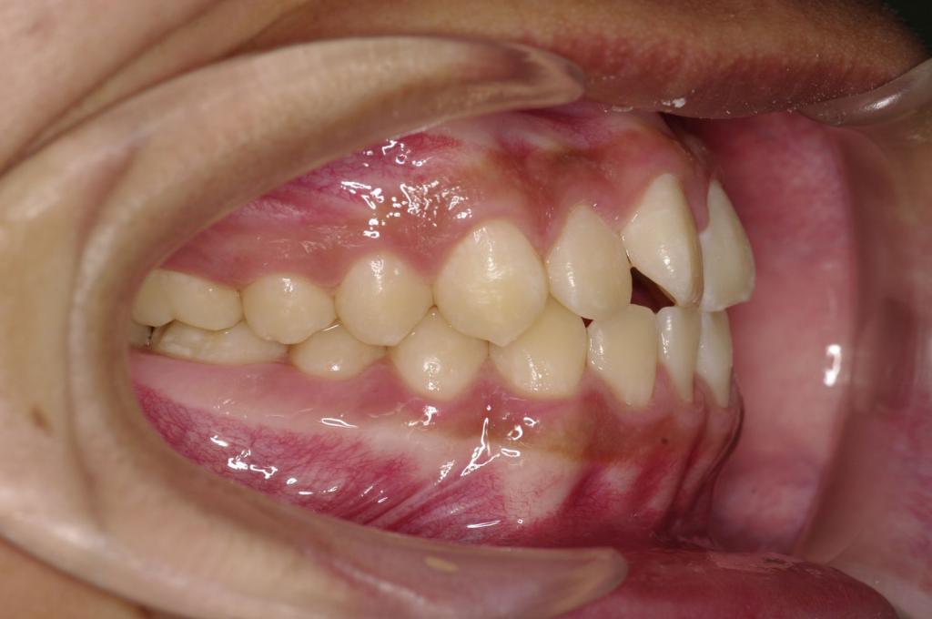 歯並び・咬み合わせ・八重歯・乱杭歯の矯正治療前口内写真NO.1221