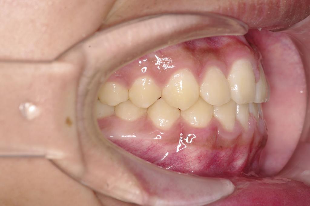 歯並び・咬み合わせ・八重歯・乱杭歯の矯正治療後口内写真NO.1221