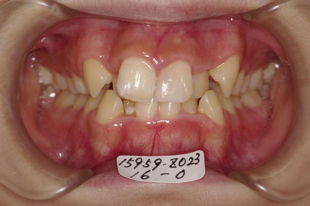 歯並び・咬み合わせ・八重歯・乱杭歯の矯正治療前口内写真NO.1222