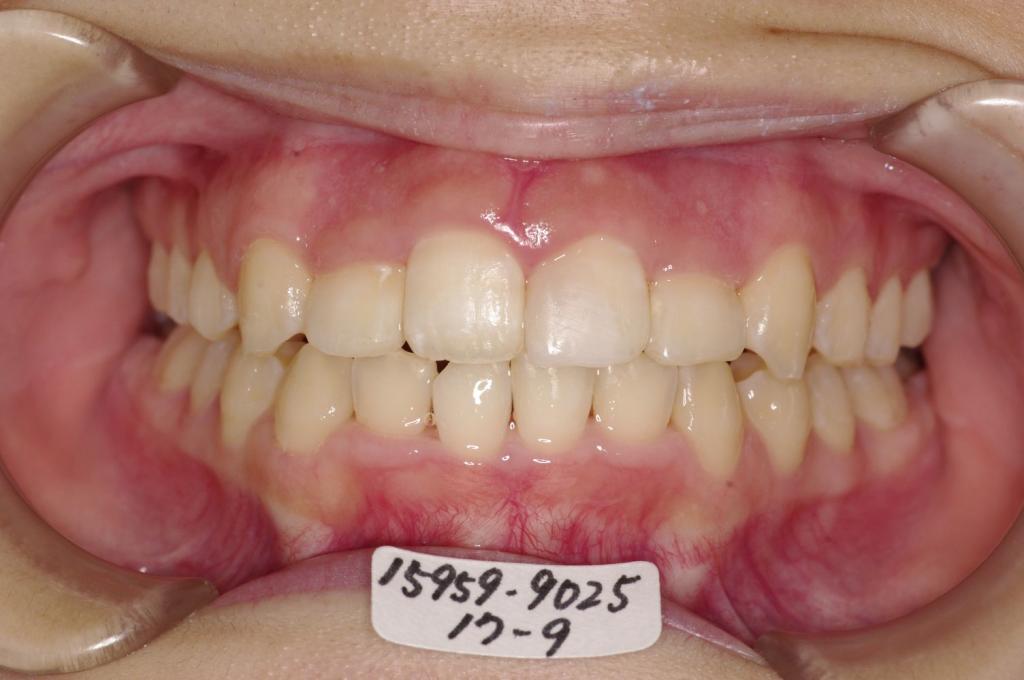 歯並び・咬み合わせ・八重歯・乱杭歯の矯正治療後口内写真NO.1222