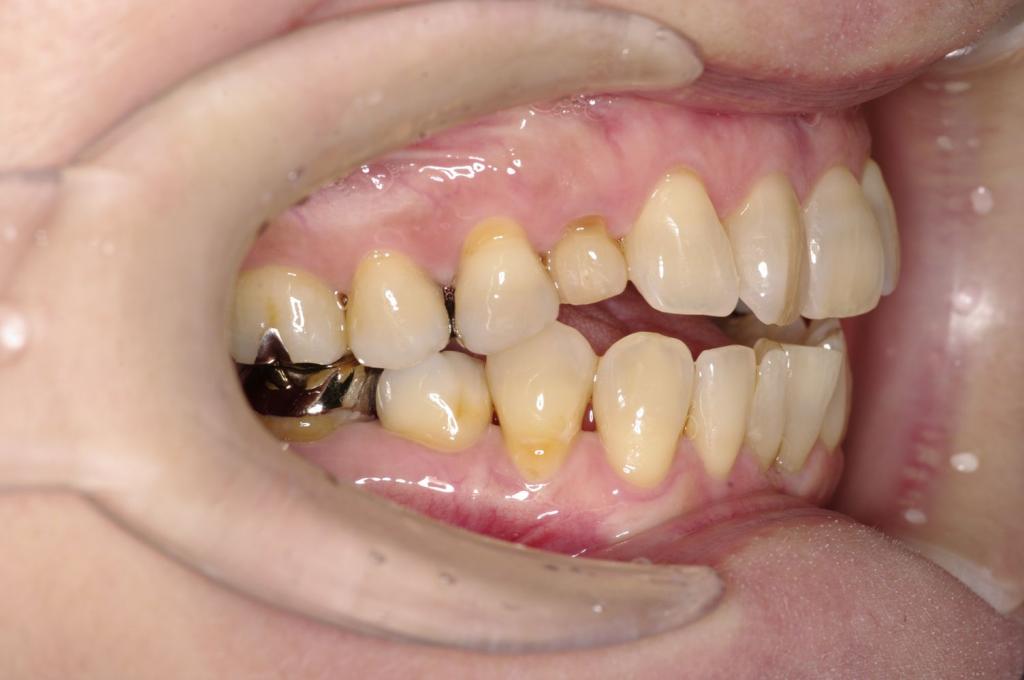 歯並び・咬み合わせ・八重歯・乱杭歯の矯正治療前口内写真NO.1223