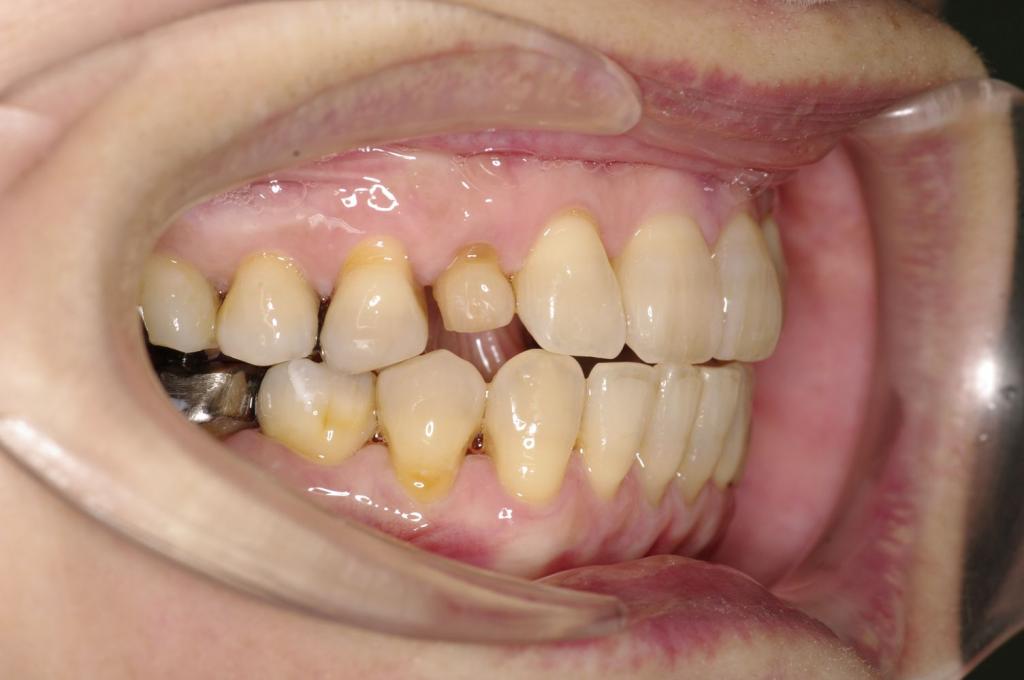 歯並び・咬み合わせ・八重歯・乱杭歯の矯正治療後口内写真NO.1223