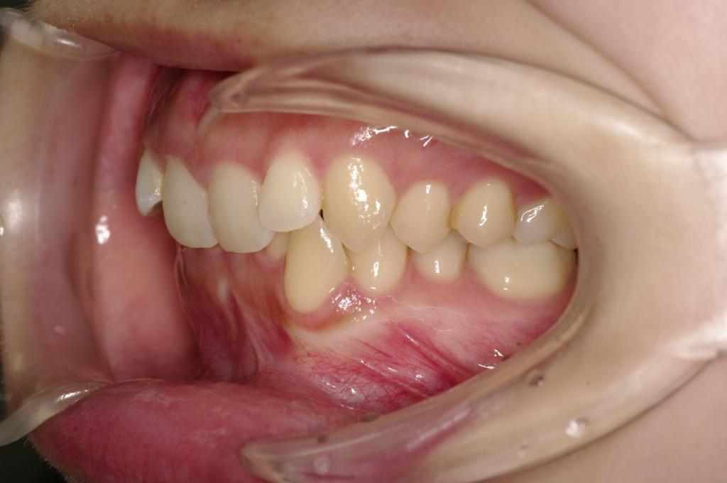 歯並び・咬み合わせ・八重歯・乱杭歯の矯正治療前口内写真NO.1224