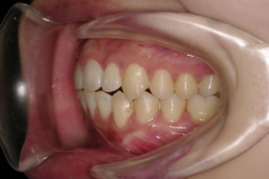 歯並び・咬み合わせ・八重歯・乱杭歯の矯正治療後口内写真NO.1224