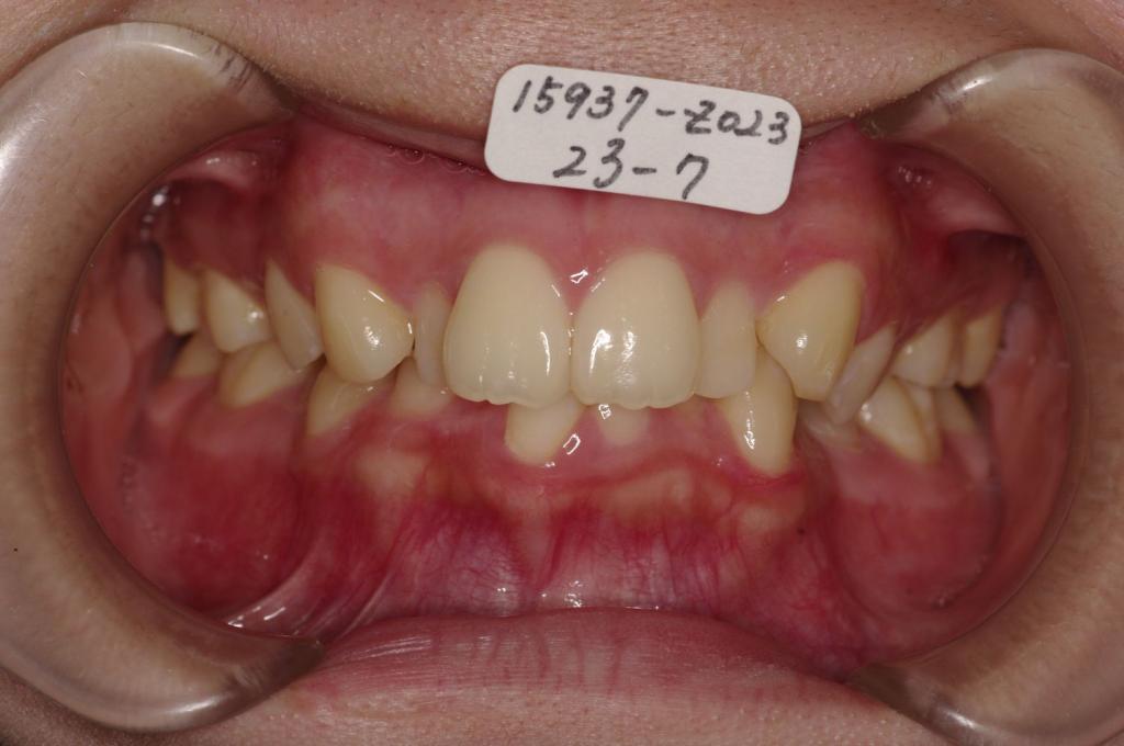 歯並び・咬み合わせ・八重歯・乱杭歯の矯正治療前口内写真NO.1225