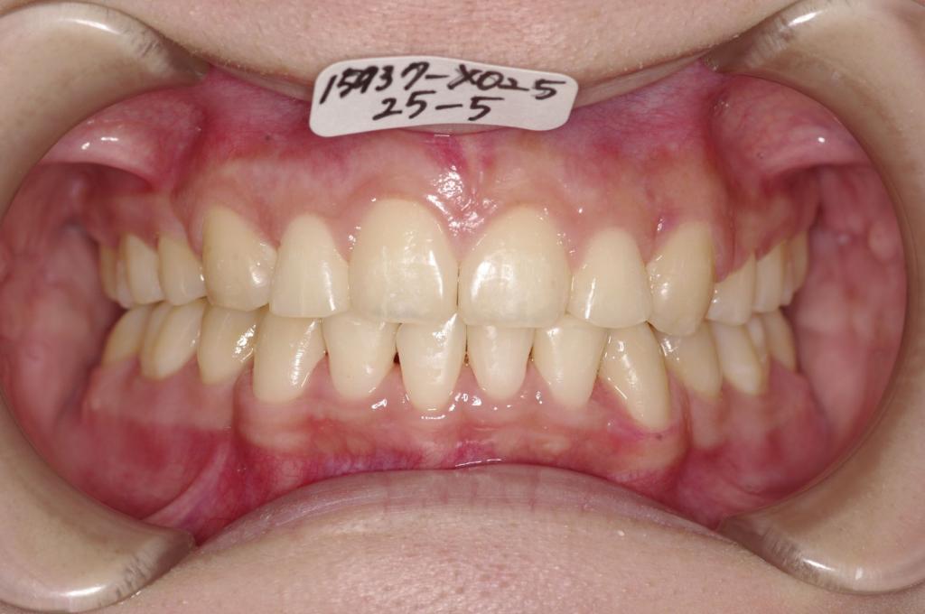 歯並び・咬み合わせ・八重歯・乱杭歯の矯正治療後口内写真NO.1225