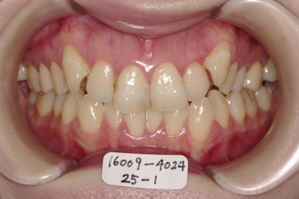 歯並び・咬み合わせ・八重歯・乱杭歯の矯正治療前口内写真NO.1226