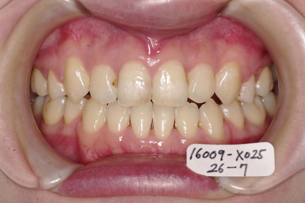 歯並び・咬み合わせ・八重歯・乱杭歯の矯正治療後口内写真NO.1226